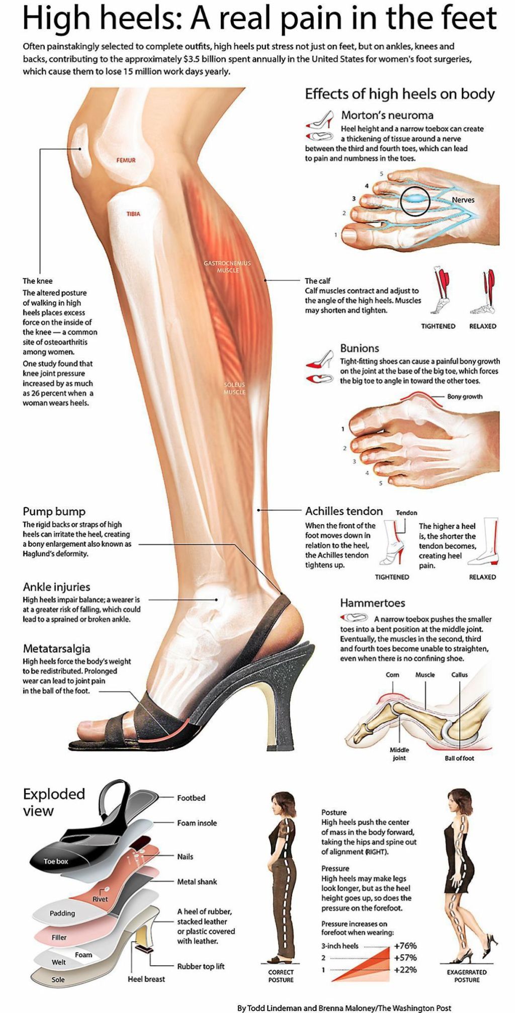 درد و ناهنجاری‌های پا پوشیدن کفش‌های نامناسب می‌تواند منجر به دردهای مزمن در ناحیه پا شود. کفش‌های تنگ یا با قالب نامناسب ممکن است باعث ایجاد میخچه، پینه و تاول در پا شوند. همچنین، فشار مداوم بر روی انگشتان می‌تواند منجر به ناهنجاری‌هایی مانند انگشت چکشی یا انحراف شست پا شود.